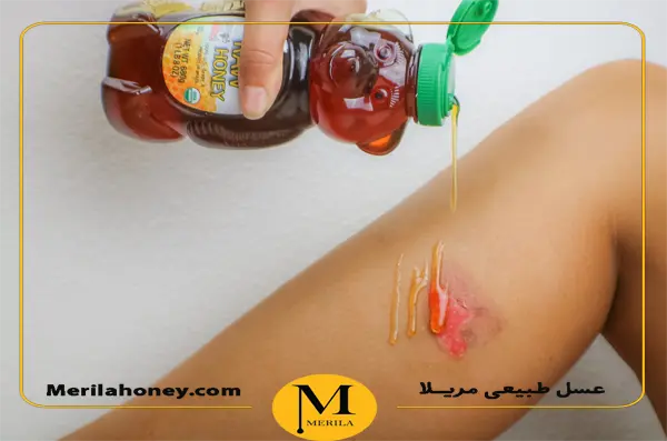 عسل برای  درمان سوختگی و زخم